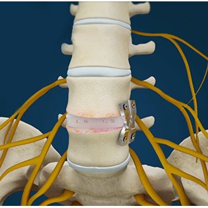 Lumbar Interbody Fusion pic