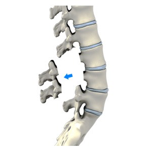Lumbar Laminectomy pic
