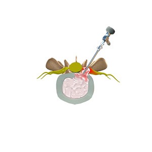 Lumbar Microdiscectomy pic