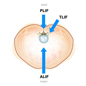 Minimally Invasive Lumbar Fusion pic