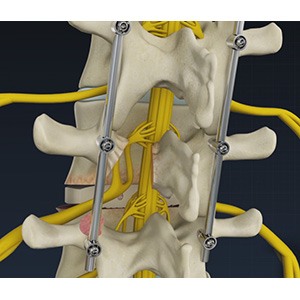 Minimally Invasive TLIF pic