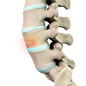 Spinal Compression Fractures pic