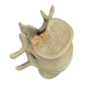 Spinal Tumor Surgery pic