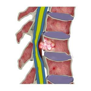 Spine Tumors pic