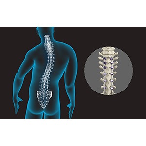 Spine Deformity Surgery pic