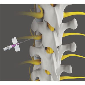 Spine Injections pic