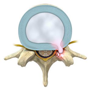 Thoracic Disc Herniation pic