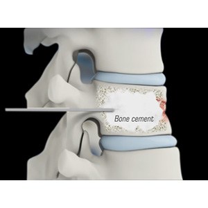 Thoracic Kyphoplasty pic