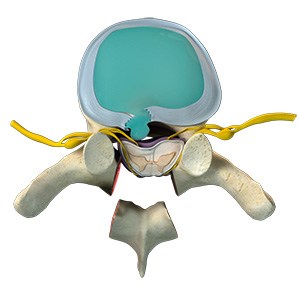 Thoracic Spine Decompression pic