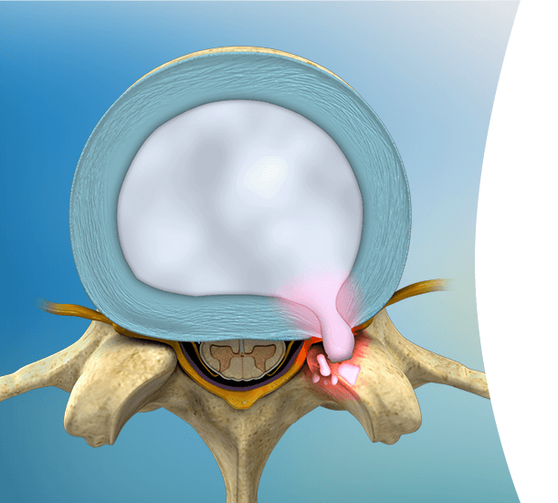 Cervical & Lumbar Disk Problems Pic