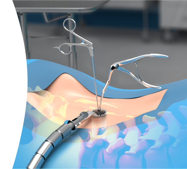 Minimally Invasive Spine Surgery Pic