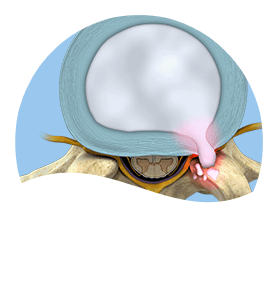 cervical & lumbar disk problems Pic