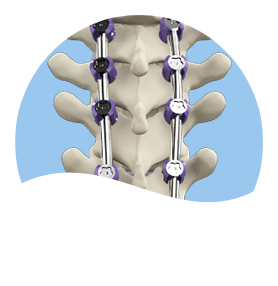 complex adult spinal deformity surgery Pic