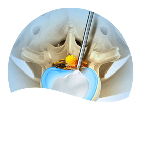 minimally invasive spinal surgery Pic