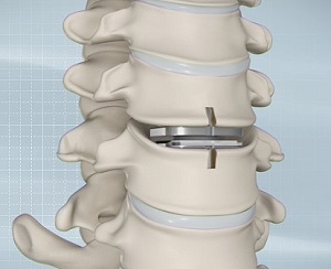 Artificial Cervical Disc Replacement pic