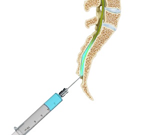 Caudal Epidural Injection pic