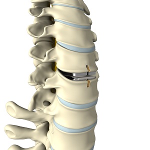 Cervical Arthroplasty pic