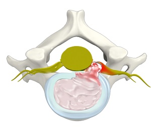 Herniated Disc (Cervical) pic