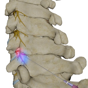 Cervical Facet Blocks pic