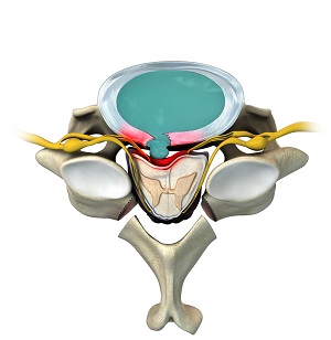 Cervical Laminectomy and Fusion pic