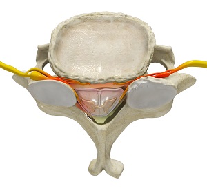 Cervical Stenosis pic