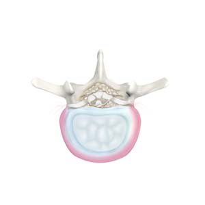 Degenerative Disc Disease pic