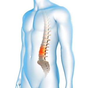 Degenerative Spinal Conditions pic