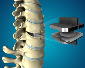 Disc Arthroplasty pic