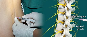 Epidural Spinal Injection pic