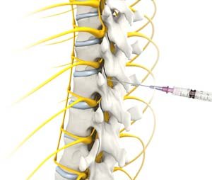 Epidural Steroid Injections pic