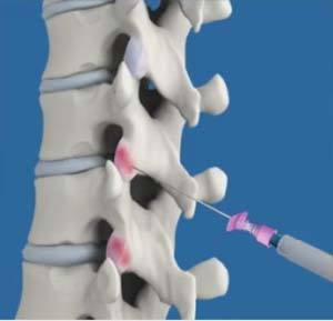 Facet Injections pic