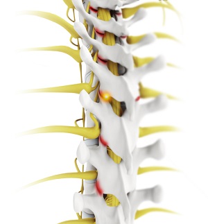 Facet Joint Arthritis pic