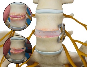 Lateral Lumbar Interbody Fusion pic