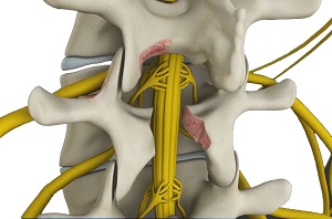 Lumbar Decompression pic