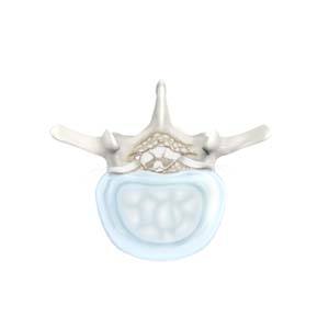 Lumbar Degenerative Disc Disease pic