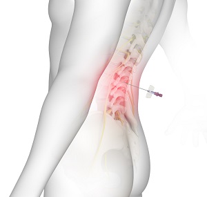 Lumbar Epidurals pic