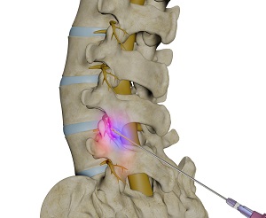 Lumbar Facet Block pic