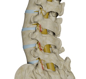 Lumbar Facet Joint Arthropathy pic