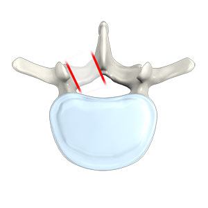 Lumbar Facetectomy and Foraminotomy pic