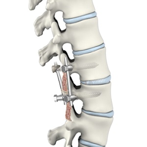 Lumbar Interbody Fusion pic