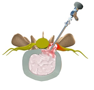 Lumbar Microdiscectomy pic
