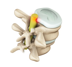Lumbar Radiculopathy pic