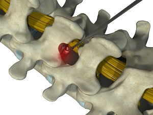 Microdiscectomy pic
