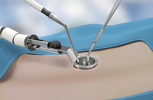 Microscopic Spine Surgery pic
