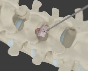 Minimally Invasive Lumbar Discectomy pic