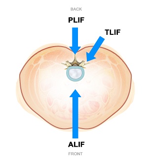 Minimally Invasive Lumbar Fusion pic