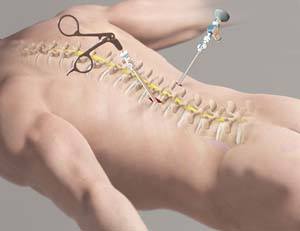 Minimally Invasive Spine Surgery pic