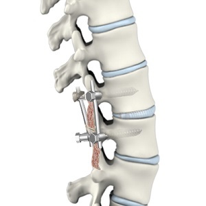 Posterior Lumbar Interbody Fusion pic