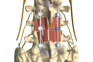 Posterolateral Lumbar Fusion pic