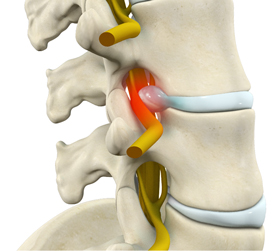 Radiculopathy pic